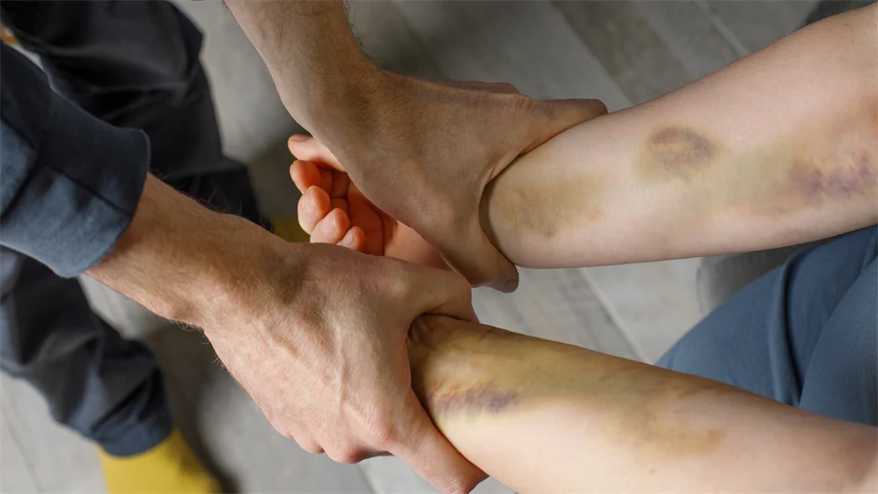 Manshänder håller fast en kvinnas underarmar, full av blåmärken